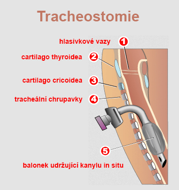 Thoraxové odsávačky, hrudné odsávanie